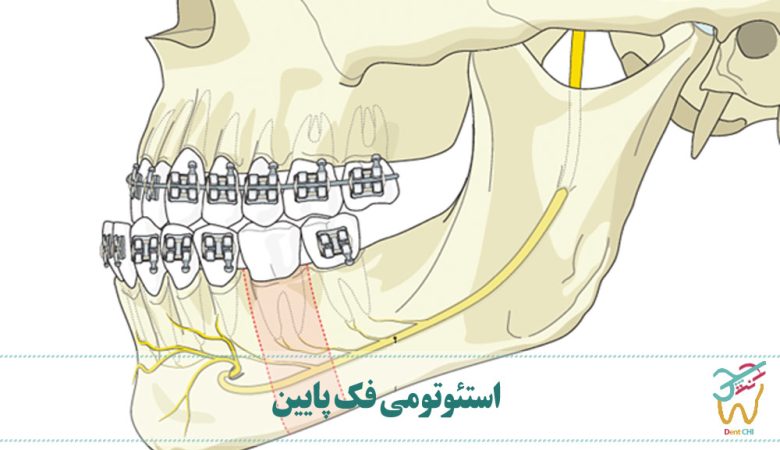 استئوتومی فک پایین
