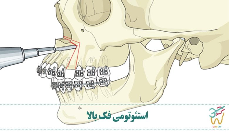 استئوتومی فک بالا