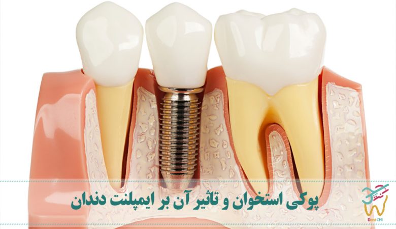 پوکی استخوان و تاثیر آن بر ایمپلنت دندان
