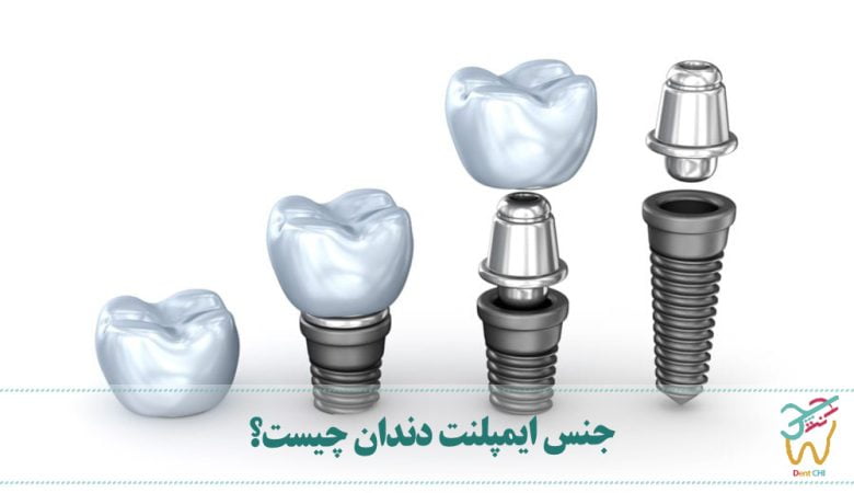 جنس ایمپلنت دندان چیست؟