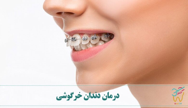 درمان دندان خرگوشی