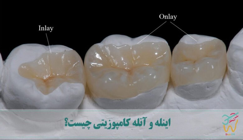 اینله و آنله کامپوزیتی چیست؟