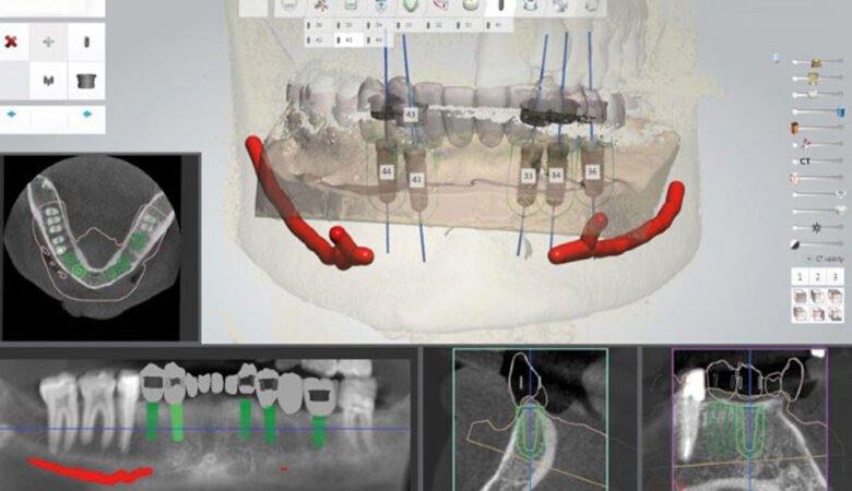 ایمپلنت دیجیتال چیست؟