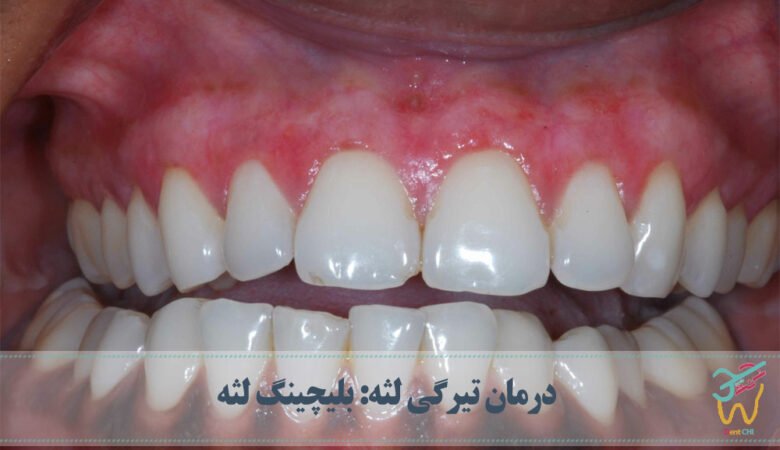 درمان تیرگی لثه: بلیچینگ لثه