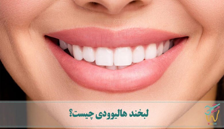 لبخند هالیوودی چیست؟