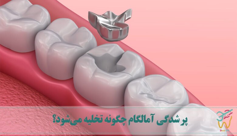 پر شدگی‌ آمالگام چگونه تخلیه می‌شود؟