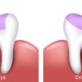 اینله و آنله دندان چیست؟