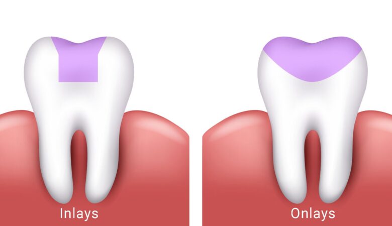 اینله و آنله دندان چیست؟