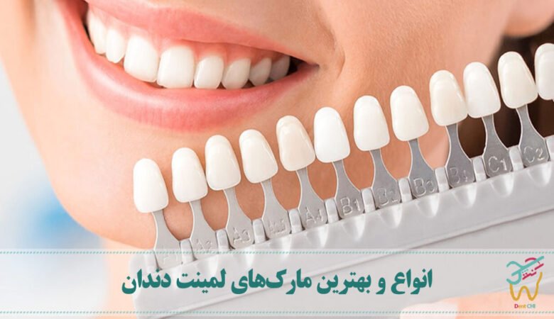 انواع و بهترین مارک‌ لمینت دندان