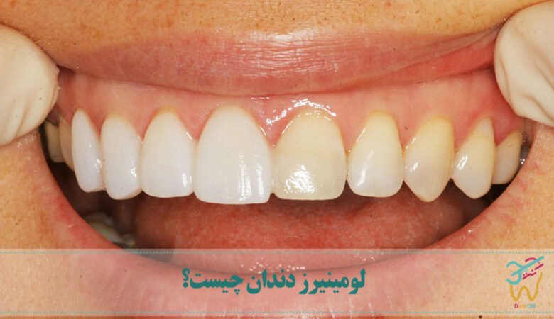 لومینیرز دندان چیست؟