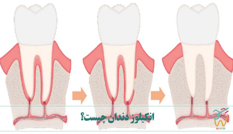 انکیلوز دندان چیست؟