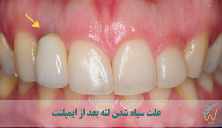 علت سیاه شدن لثه بعد از ایمپلنت چیست؟