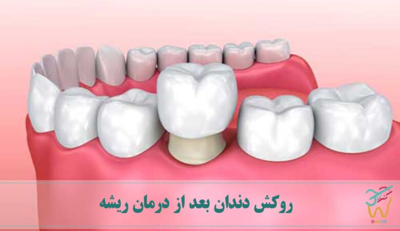 روکش دندان بعد از درمان ریشه