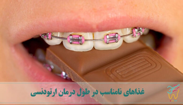 غذاهایی که در صورت استفاده از بریس‌های دندانی باید از آن‌ها اجتناب کنید