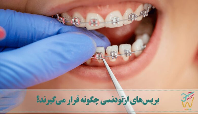بریس‌های ارتودنسی چگونه قرار می‌گیرند؟