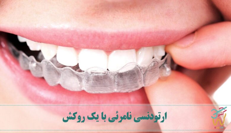 ارتودنسی نامرئی با یک روکش