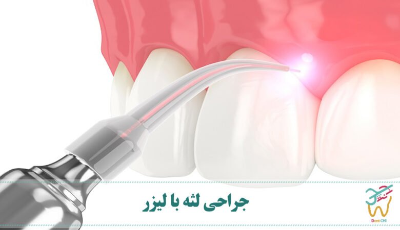 جراحی لثه با لیزر