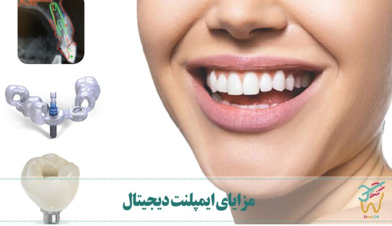 مزایای ایمپلنت دیجیتال