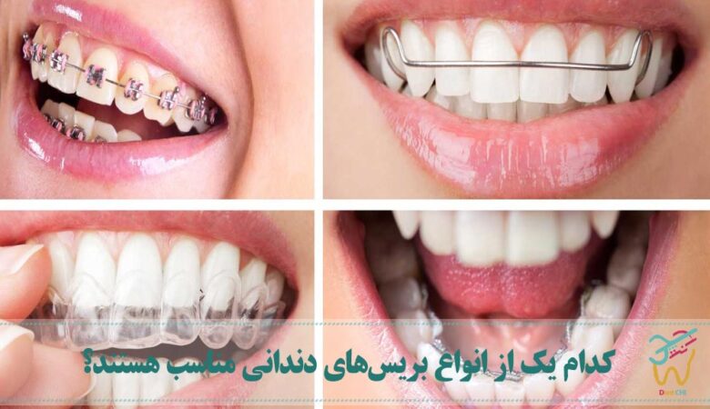 کدام یک از انواع بریس‌های دندانی مناسب هستند؟
