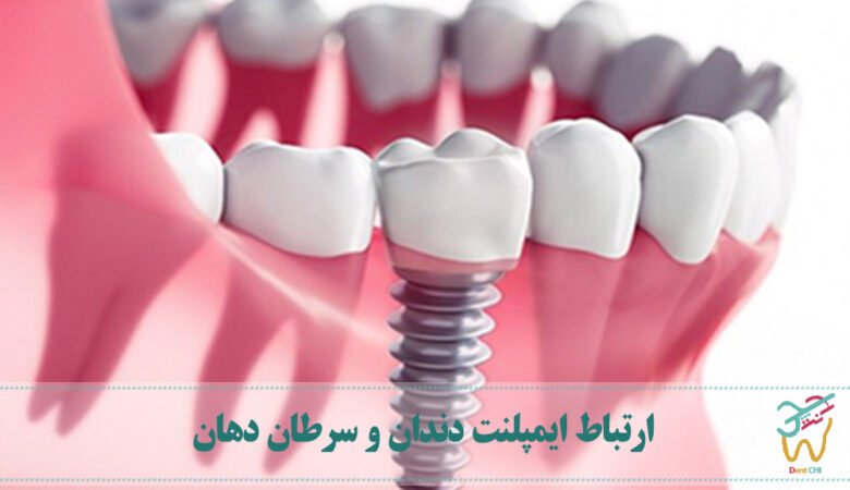 ارتباط ایمپلنت دندان و سرطان دهان