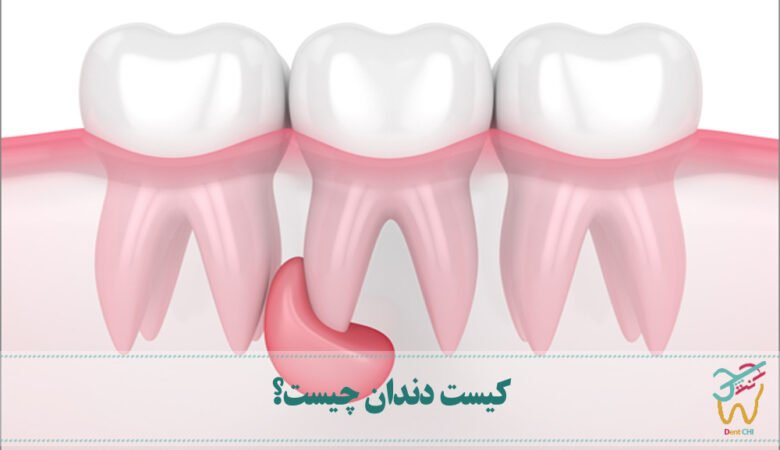 کیست دندان چیست؟