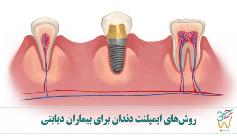 روش‌های ایمپلنت دندان برای بیماران دیابتی