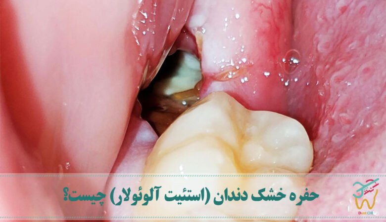 حفره خشک دندان (استئیت آلوئولار) چیست؟
