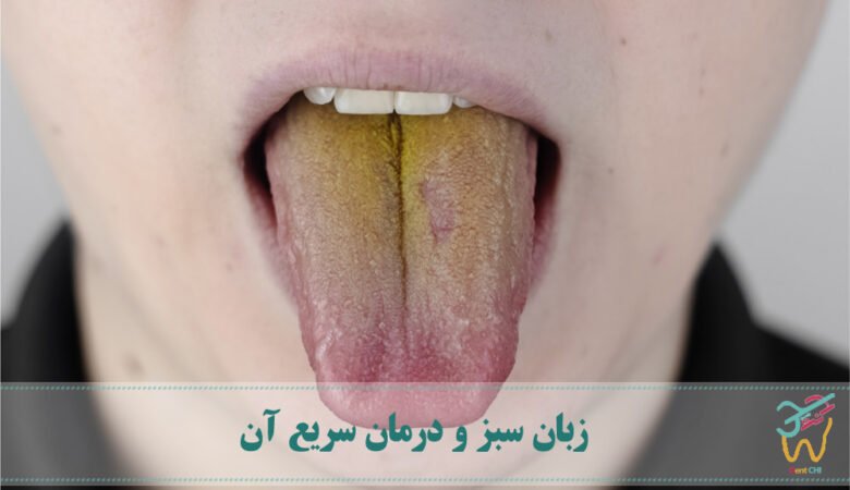 زبان سبز و درمان سریع آن