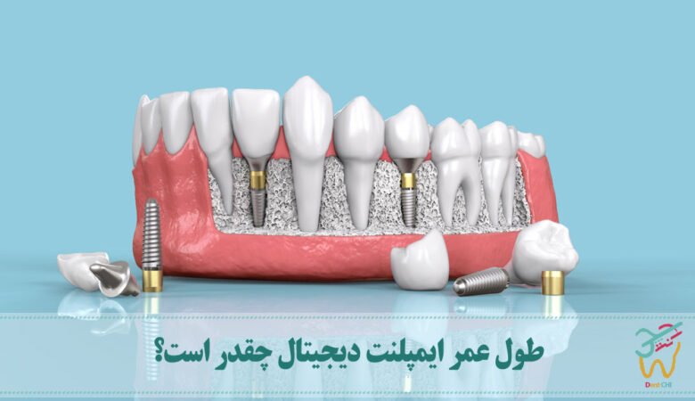 طول عمر ایمپلنت دیجیتال چقدر است؟