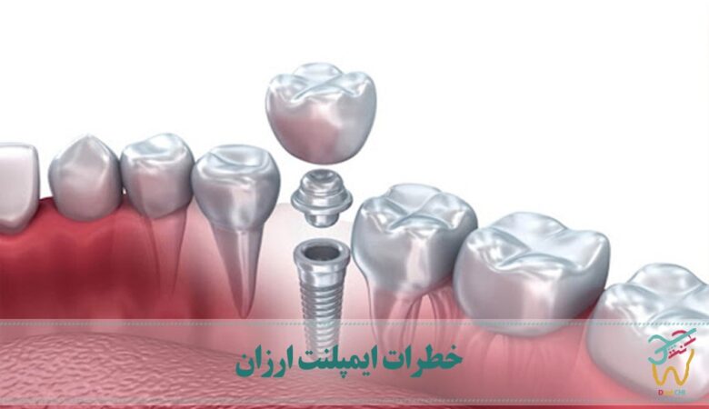 خطرات ایمپلنت ارزان