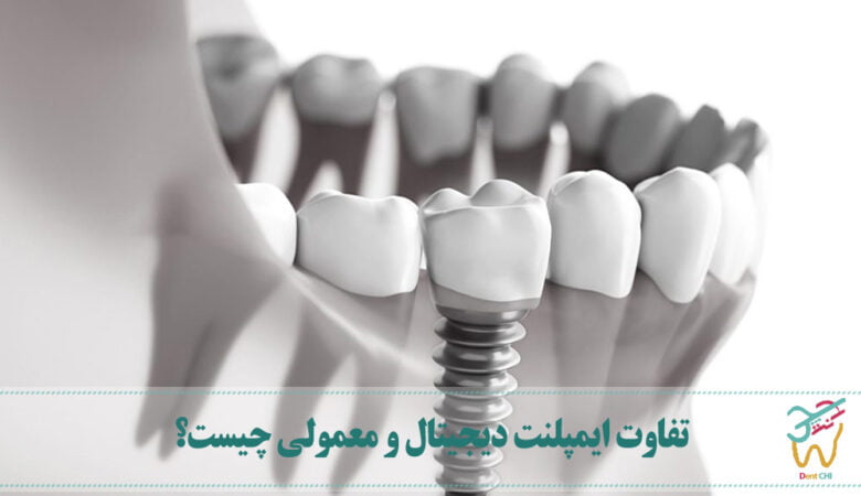 تفاوت ایمپلنت دیجیتال و معمولی چیست؟
