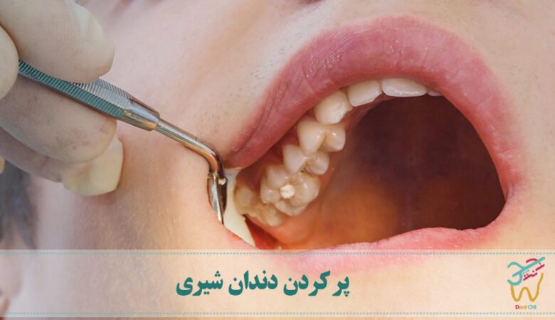 پر کردن دندان شیری