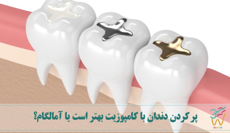 پر کردن دندان با کامپوزیت بهتر است یا آمالگام؟