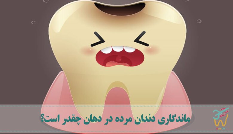 ماندگاری دندان مرده در دهان چقدر است؟