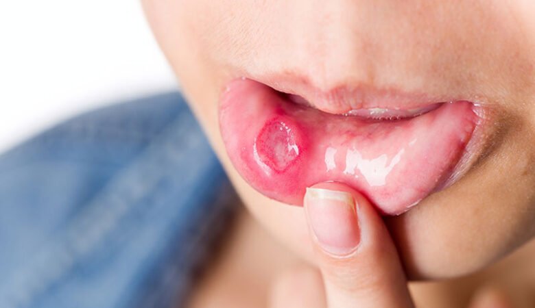 آفت دهان، علائم، علت و روش‌های درمان