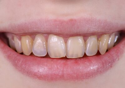 فرسایش مینای دندان چیست؟