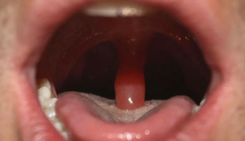 التهاب زبان کوچک