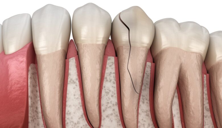 تسکین درد دندان ترک خورده یا شکسته