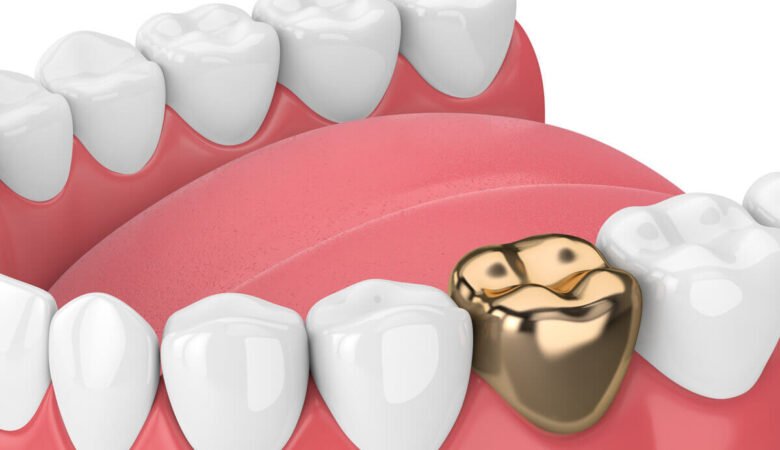 روکش دندان طلا