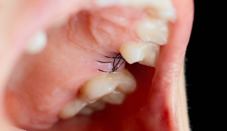 بخیه دندان چه مدت باید در دهان باقی بماند؟
