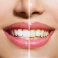 جلوگیری از زرد شدن کامپوزیت دندان