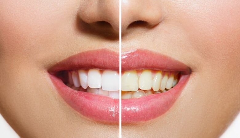 جلوگیری از زرد شدن کامپوزیت دندان