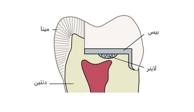 اهمیت و کاربرد بیس و لاینر در دندانپزشکی