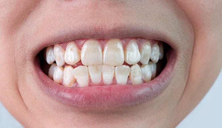 درمان لکه‌های سفید روی دندان بعد از برداشتن بریس