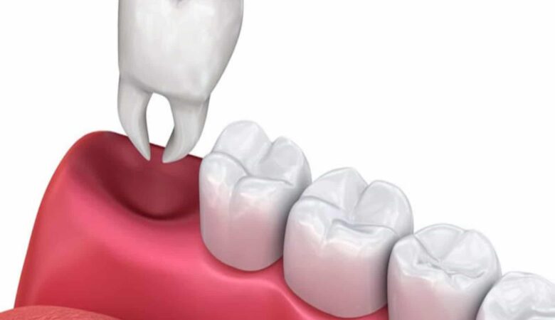 تاثیر کشیدن دندان بر ساختار صورت