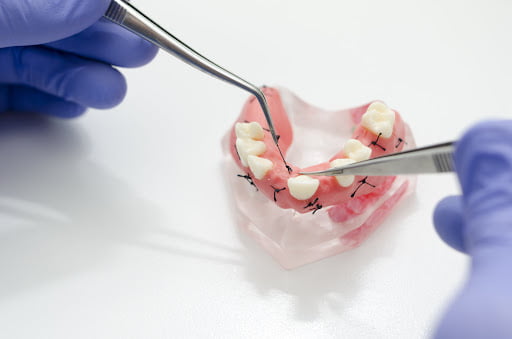 انواع نخ بخیه در دندانپزشکی