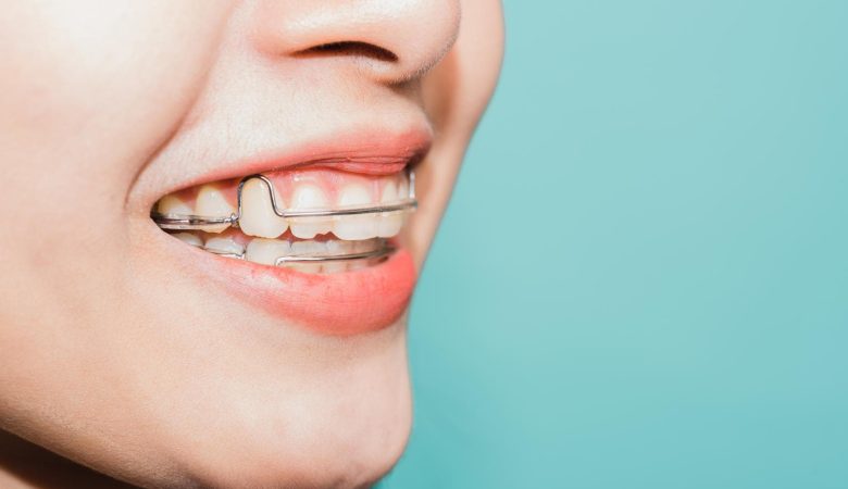 نگهدارنده ثابت ارتودنسی چیست؟