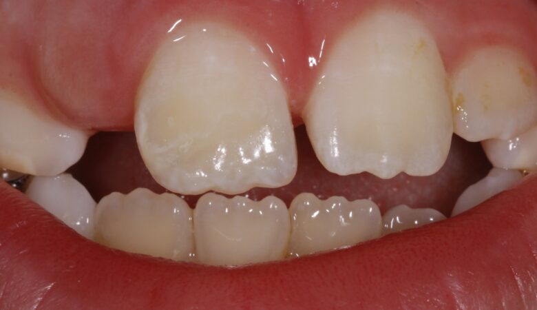 ماملون دندان چیست؟