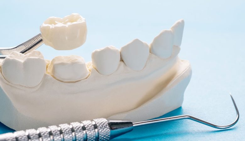 بهترین روکش دندان کدام است؟