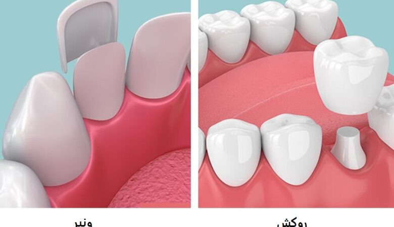 تفاوت ونیر و روکش دندان چیست؟